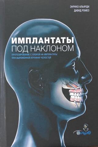 Импланты под наклоном. Протезирование с опорой на импланты при выраженной атрофии челюстей