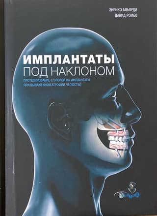 Angled implants. Implant-supported prosthetics for severe jaw atrophy.
