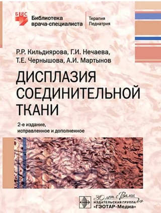 Дисплазия соединительной ткани